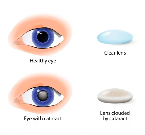 Heathy eye compared to eye with cataract